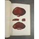 Médecine Caussade de la néphrite pneumonique Stenheil 1890 Planches Hors texte