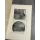 Médecine Jean Marchak Traitement des fractures du Fémur et de son col Methode Delbet 1919 Envoi à Souligoux.