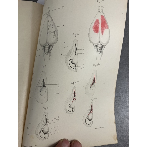 Médecine Guyon Hyperthermie centrale consecutive aux Lesions cérébro spinal cerveau Steinheil 1893